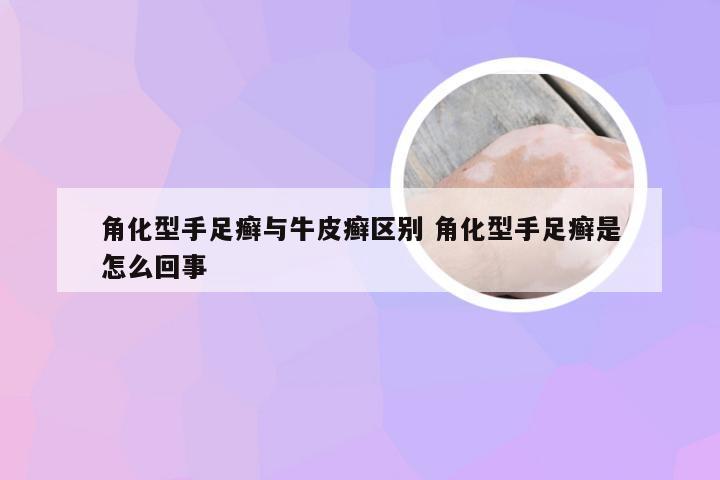 角化型手足癣与牛皮癣区别 角化型手足癣是怎么回事
