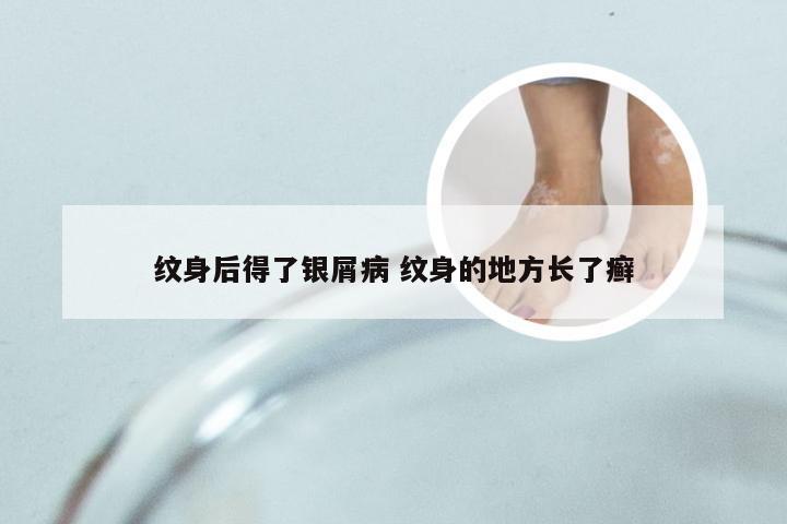 纹身后得了银屑病 纹身的地方长了癣