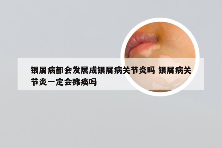 银屑病都会发展成银屑病关节炎吗 银屑病关节炎一定会瘫痪吗