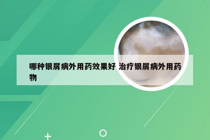 哪种银屑病外用药效果好 治疗银屑病外用药物