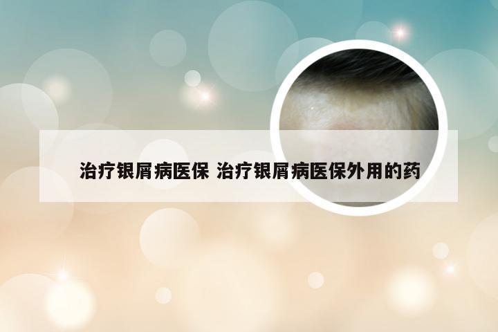 治疗银屑病医保 治疗银屑病医保外用的药