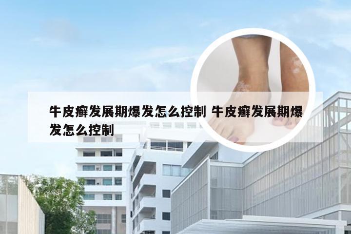 牛皮癣发展期爆发怎么控制 牛皮癣发展期爆发怎么控制