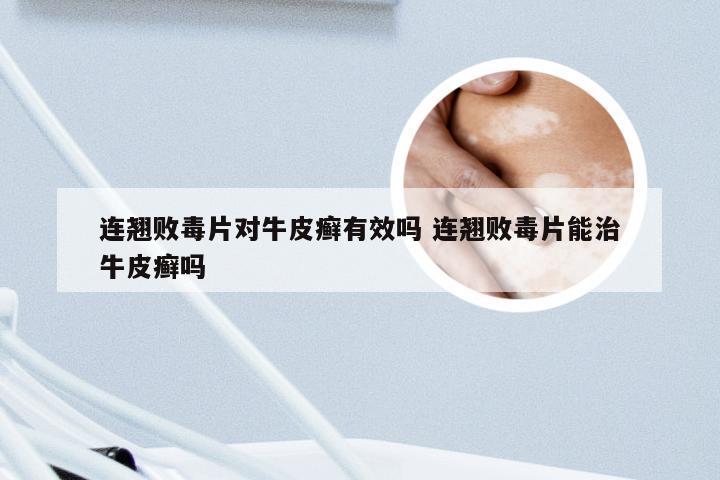 连翘败毒片对牛皮癣有效吗 连翘败毒片能治牛皮癣吗