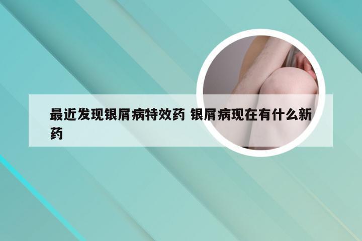 最近发现银屑病特效药 银屑病现在有什么新药