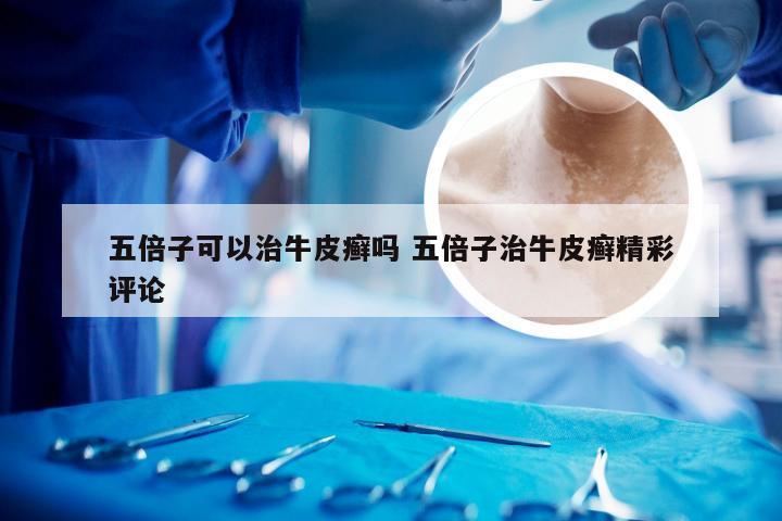 五倍子可以治牛皮癣吗 五倍子治牛皮癣精彩评论