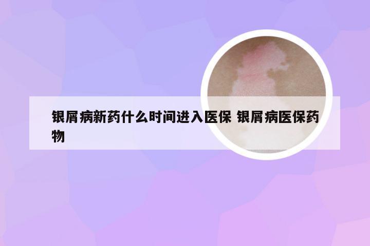 银屑病新药什么时间进入医保 银屑病医保药物
