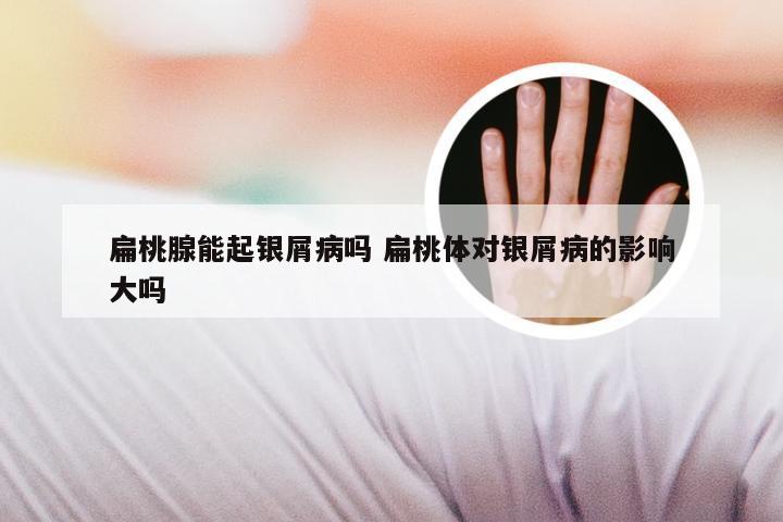 扁桃腺能起银屑病吗 扁桃体对银屑病的影响大吗