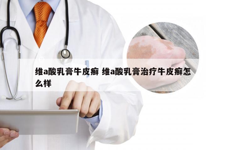 维a酸乳膏牛皮癣 维a酸乳膏治疗牛皮癣怎么样