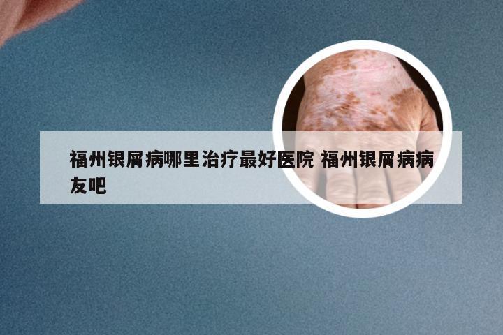 福州银屑病哪里治疗最好医院 福州银屑病病友吧