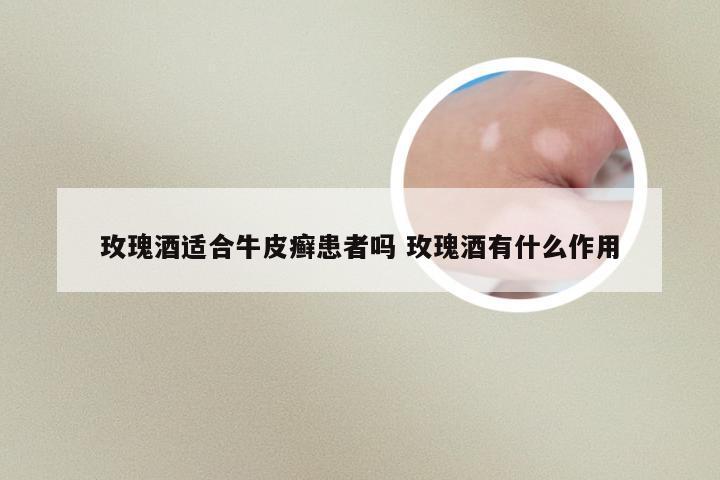 玫瑰酒适合牛皮癣患者吗 玫瑰酒有什么作用