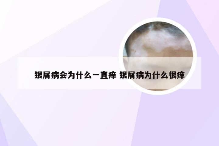 银屑病会为什么一直痒 银屑病为什么很痒