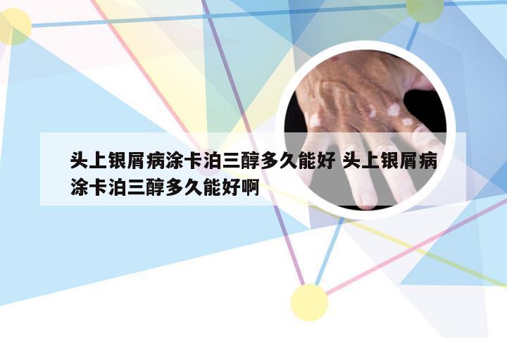 头上银屑病涂卡泊三醇多久能好 头上银屑病涂卡泊三醇多久能好啊