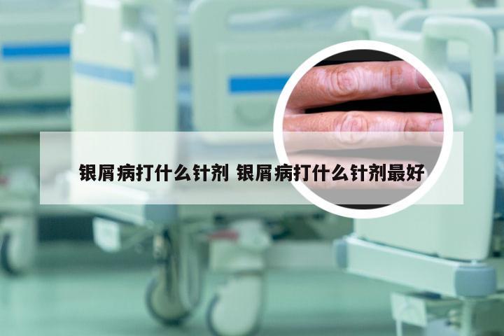 银屑病打什么针剂 银屑病打什么针剂最好
