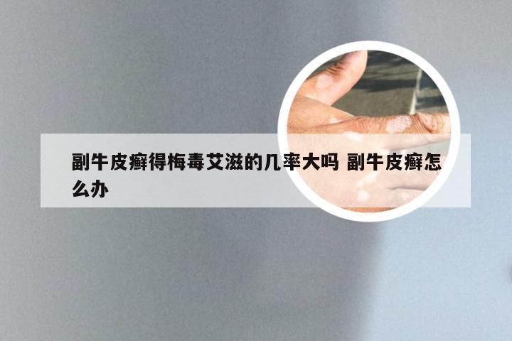 副牛皮癣得梅毒艾滋的几率大吗 副牛皮癣怎么办