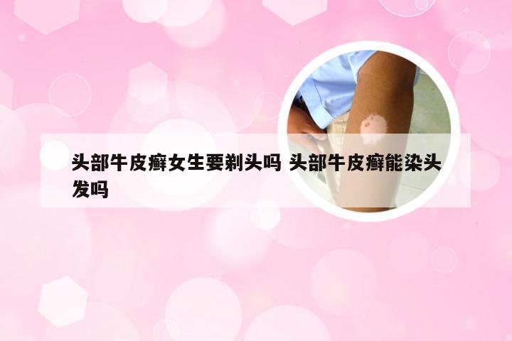 头部牛皮癣女生要剃头吗 头部牛皮癣能染头发吗