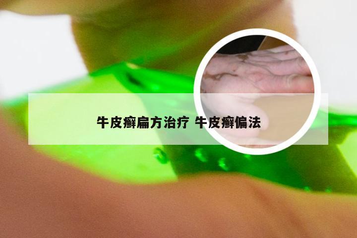 牛皮癣扁方治疗 牛皮癣偏法