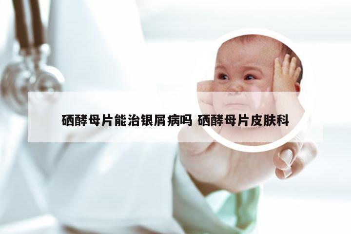 硒酵母片能治银屑病吗 硒酵母片皮肤科