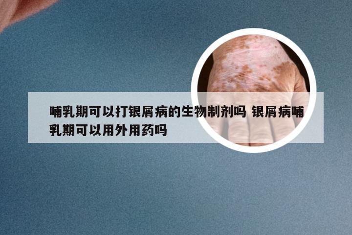 哺乳期可以打银屑病的生物制剂吗 银屑病哺乳期可以用外用药吗