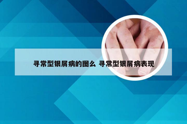 寻常型银屑病的图么 寻常型银屑病表现
