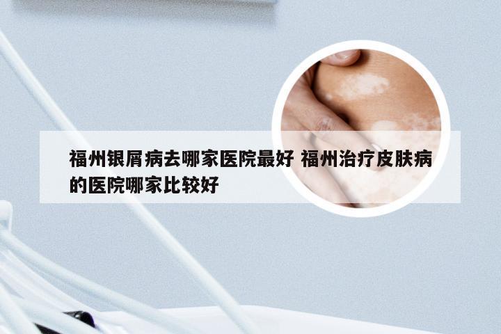 福州银屑病去哪家医院最好 福州治疗皮肤病的医院哪家比较好