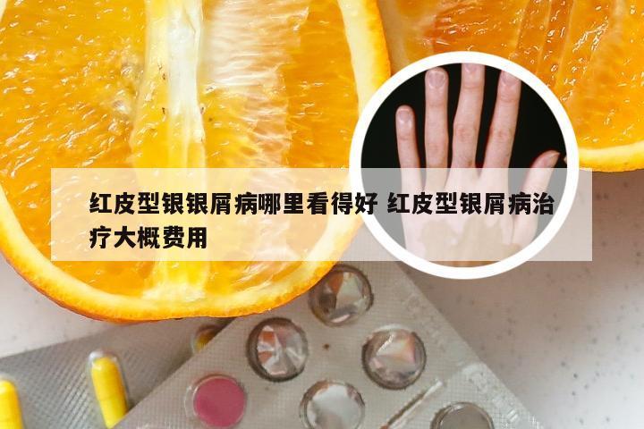 红皮型银银屑病哪里看得好 红皮型银屑病治疗大概费用