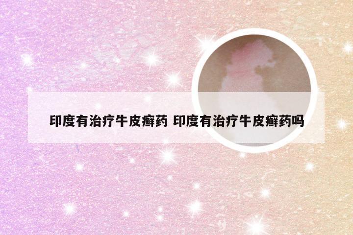 印度有治疗牛皮癣药 印度有治疗牛皮癣药吗