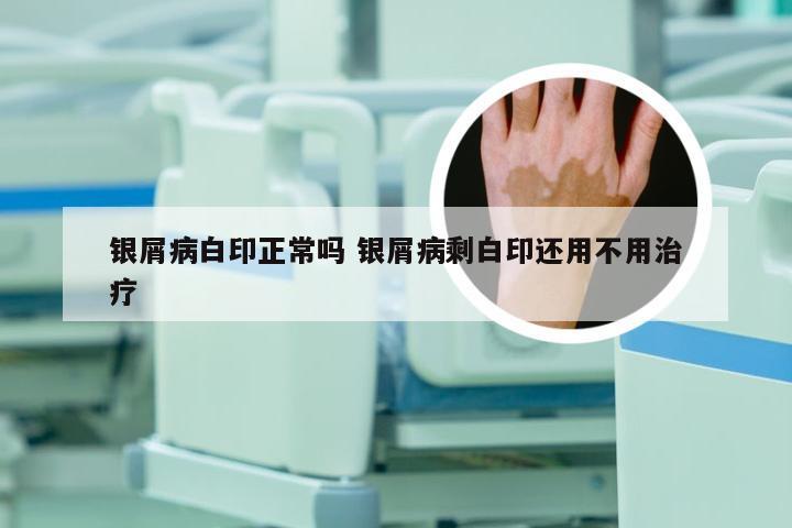 银屑病白印正常吗 银屑病剩白印还用不用治疗
