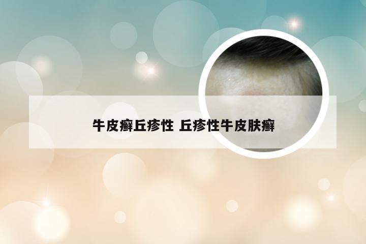 牛皮癣丘疹性 丘疹性牛皮肤癣