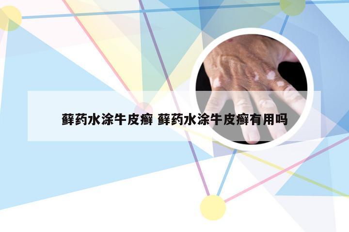 藓药水涂牛皮癣 藓药水涂牛皮癣有用吗