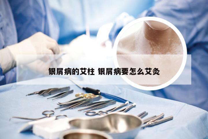 银屑病的艾柱 银屑病要怎么艾灸
