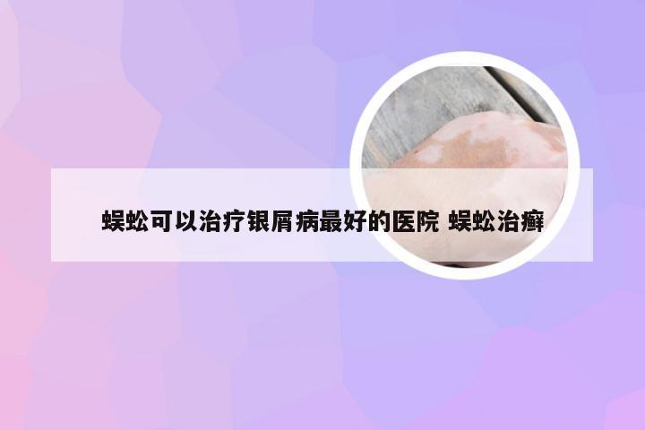 蜈蚣可以治疗银屑病最好的医院 蜈蚣治癣