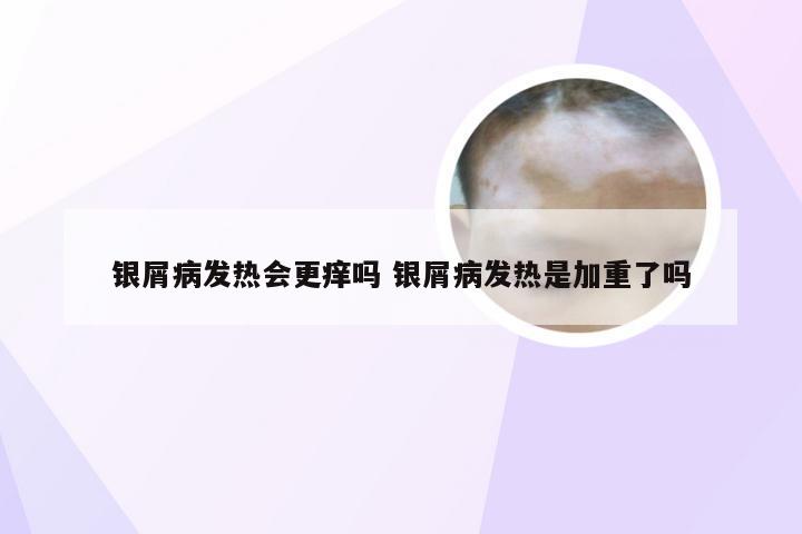 银屑病发热会更痒吗 银屑病发热是加重了吗