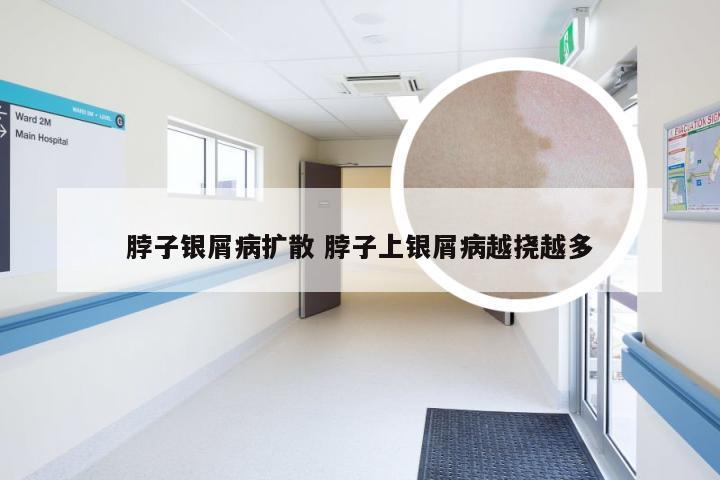 脖子银屑病扩散 脖子上银屑病越挠越多