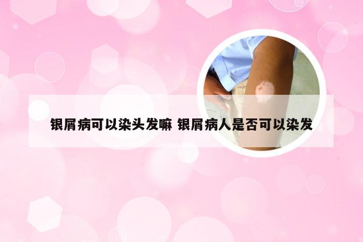 银屑病可以染头发嘛 银屑病人是否可以染发