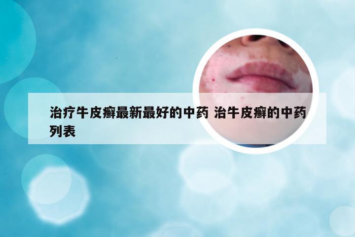 治疗牛皮癣最新最好的中药 治牛皮癣的中药列表