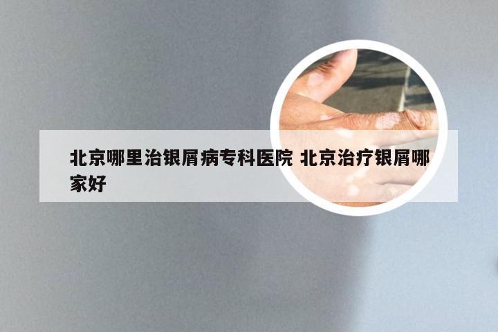 北京哪里治银屑病专科医院 北京治疗银屑哪家好
