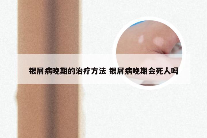 银屑病晚期的治疗方法 银屑病晚期会死人吗