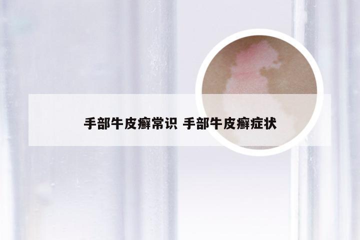 手部牛皮癣常识 手部牛皮癣症状