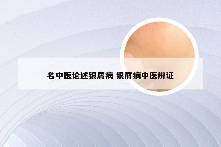名中医论述银屑病 银屑病中医辨证