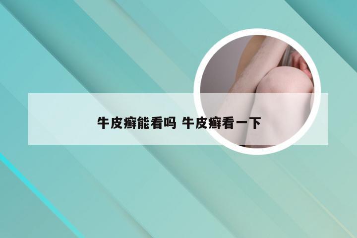 牛皮癣能看吗 牛皮癣看一下