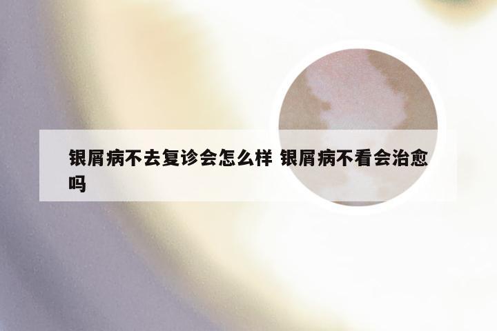 银屑病不去复诊会怎么样 银屑病不看会治愈吗
