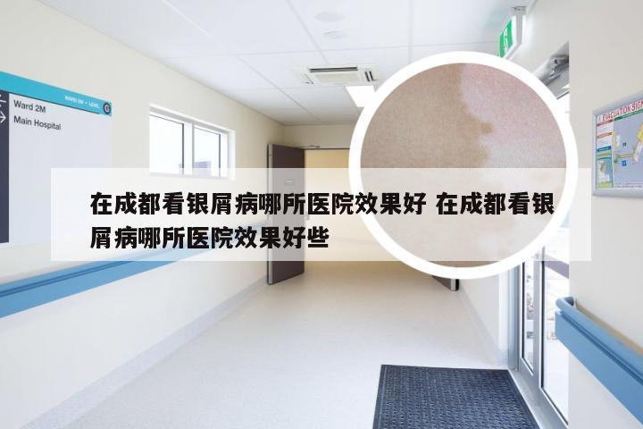 在成都看银屑病哪所医院效果好 在成都看银屑病哪所医院效果好些