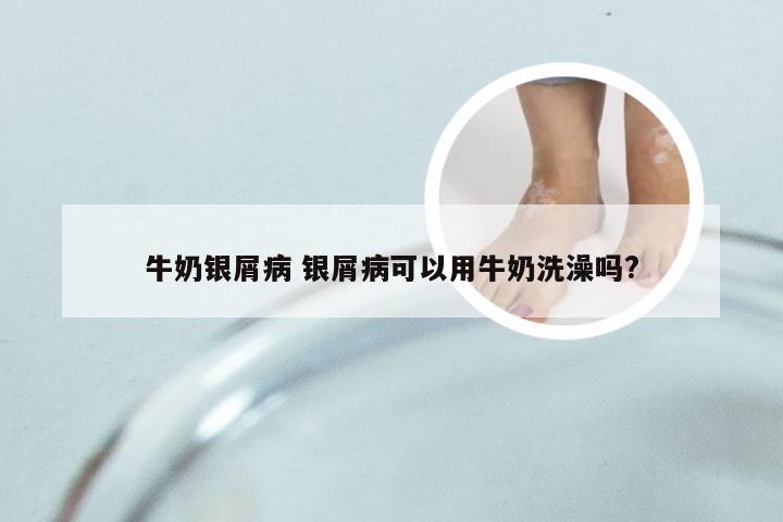 牛奶银屑病 银屑病可以用牛奶洗澡吗?