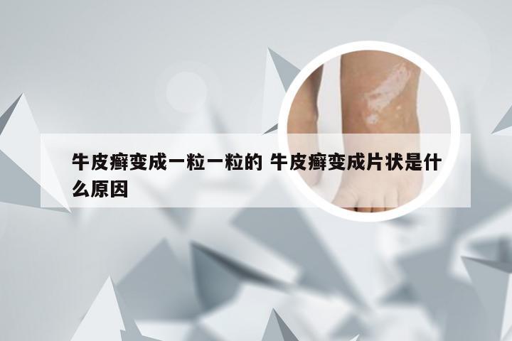 牛皮癣变成一粒一粒的 牛皮癣变成片状是什么原因