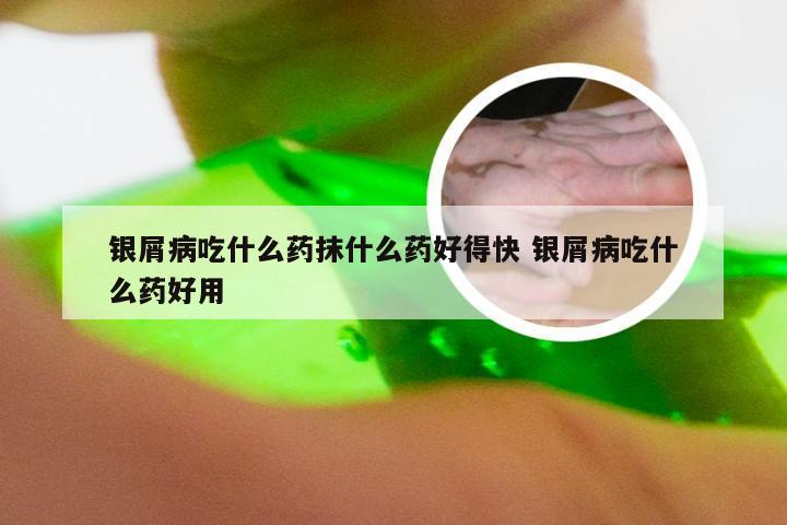 银屑病吃什么药抹什么药好得快 银屑病吃什么药好用