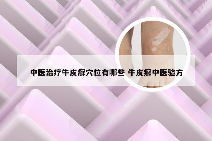 中医治疗牛皮癣穴位有哪些 牛皮癣中医验方
