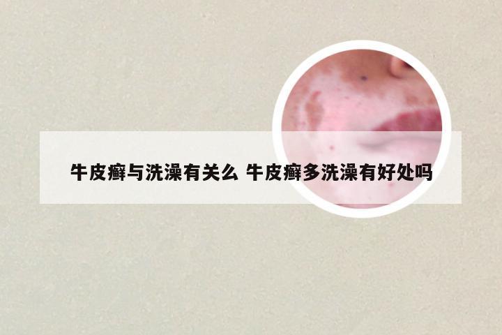 牛皮癣与洗澡有关么 牛皮癣多洗澡有好处吗