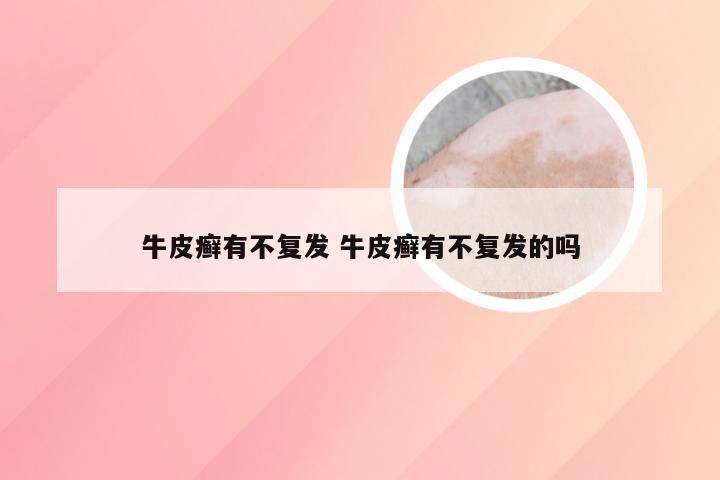牛皮癣有不复发 牛皮癣有不复发的吗
