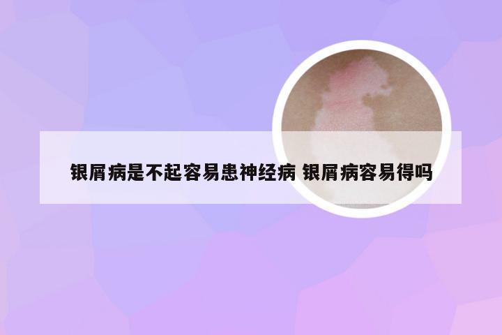 银屑病是不起容易患神经病 银屑病容易得吗