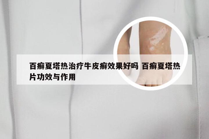 百癣夏塔热治疗牛皮癣效果好吗 百癣夏塔热片功效与作用